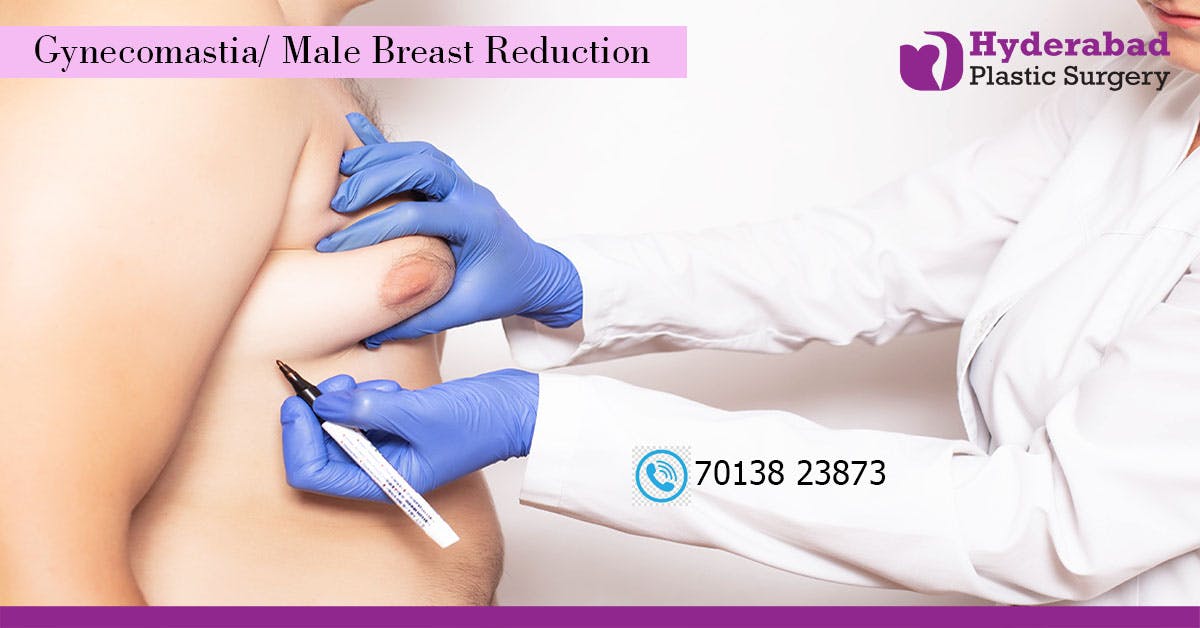 product-detail-best-gynecomastia-surgery-in-hyderabad
