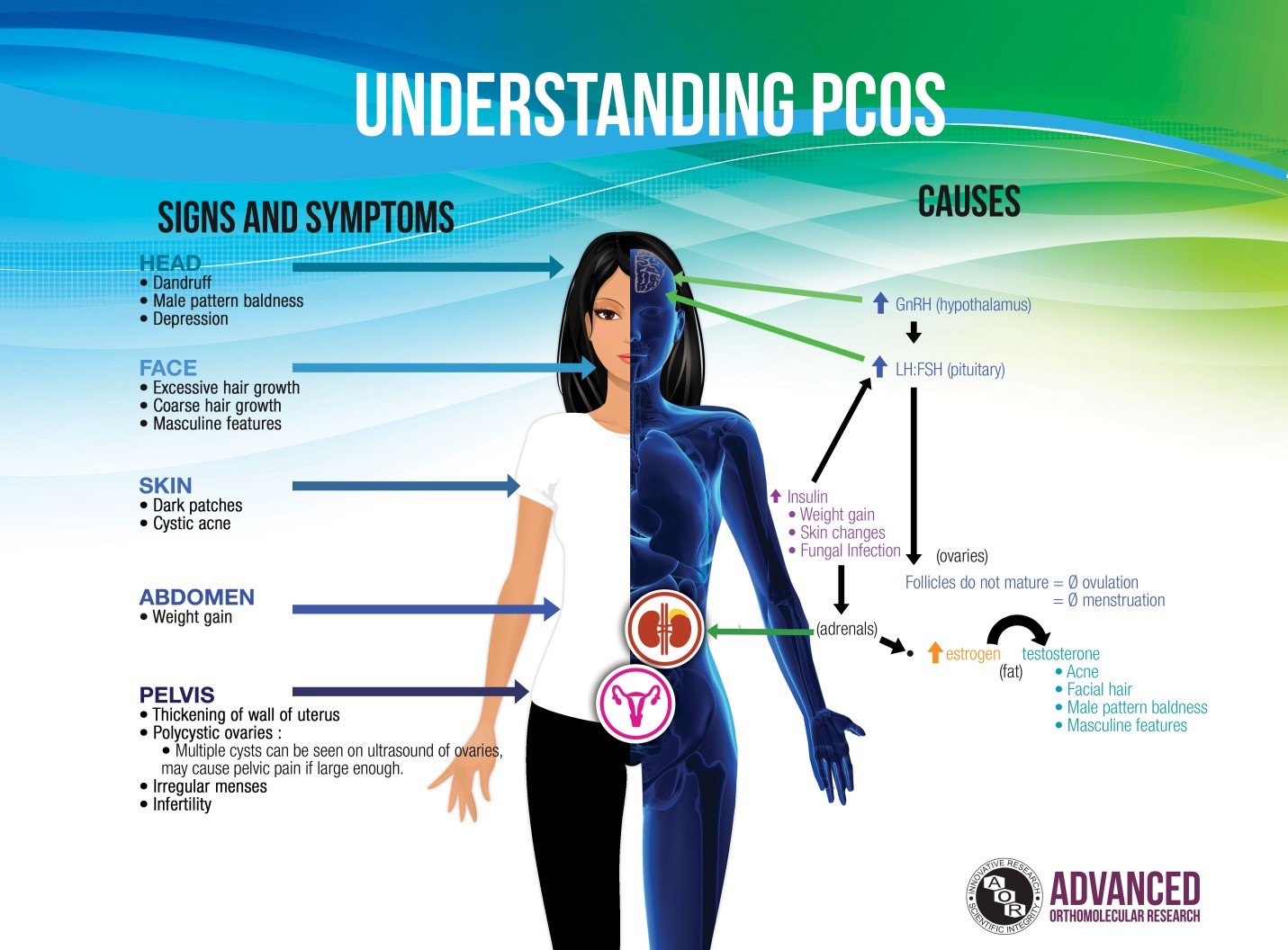 pcos-and-endometriosis-herbal-treatment
