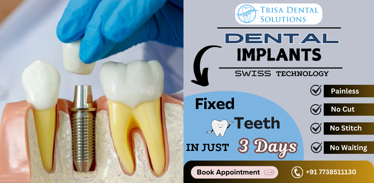 dental-implants